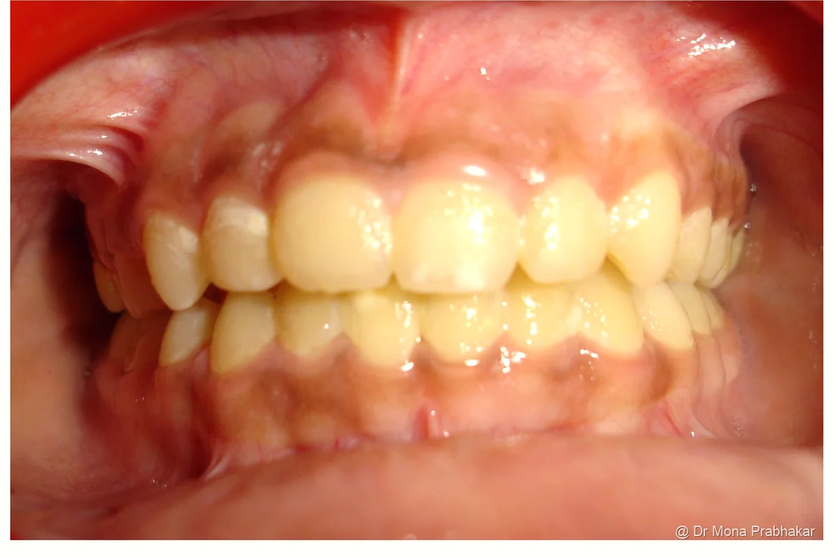 Upper front teeth aligned after treatment with braces