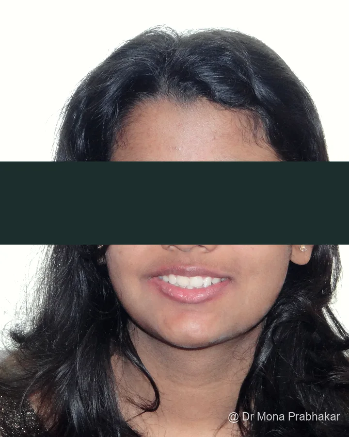 The same patient after treatment, eyes and eyebrows redacted