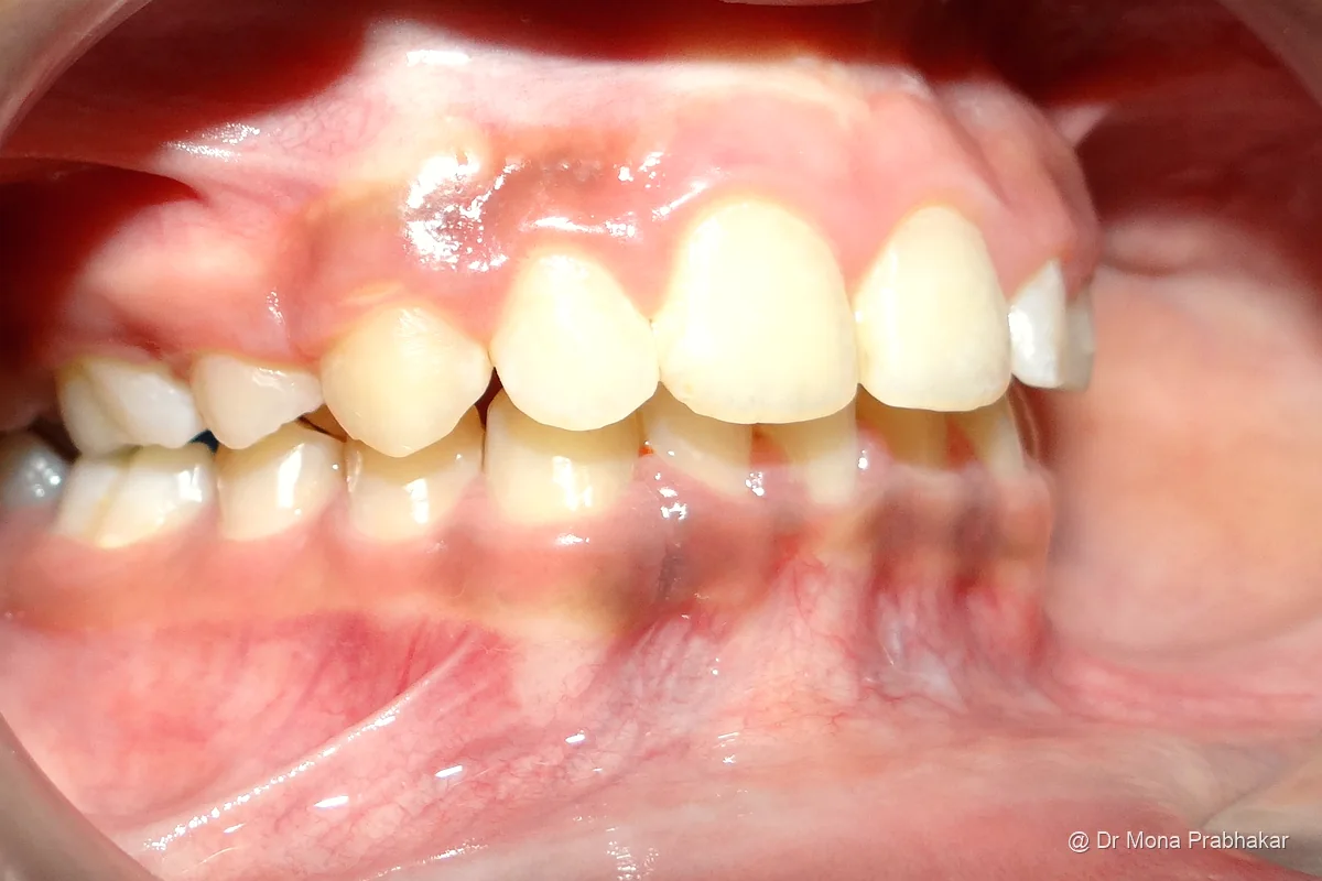 Front teeth brought back into line after treatment